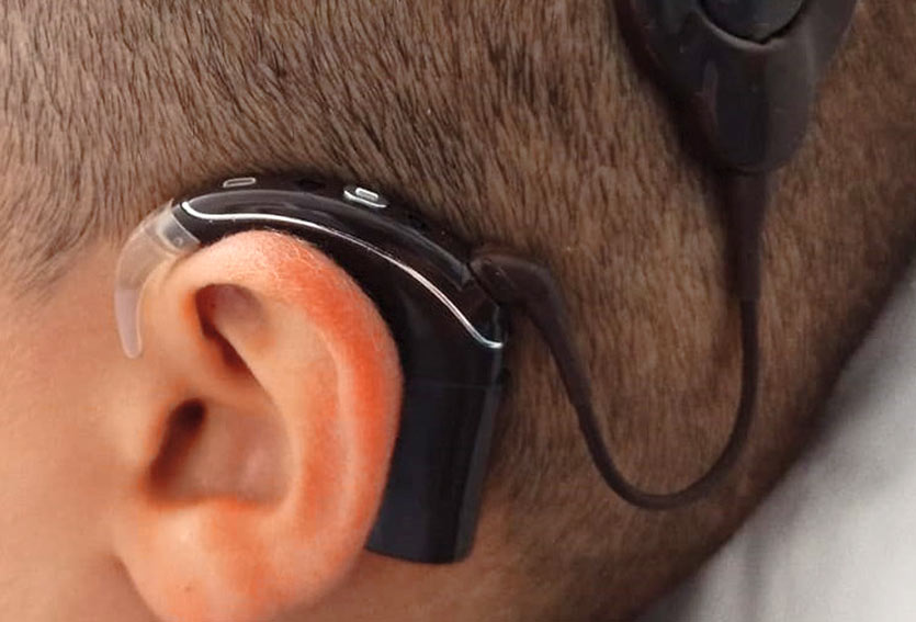 Aou di Sassari impiantato “orecchio bionico”